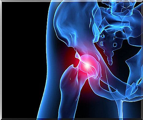 Femoroacetabular impingement