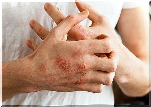 protopic atopic dermatitis