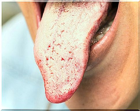 Symptoms of yeast infection on the tongue