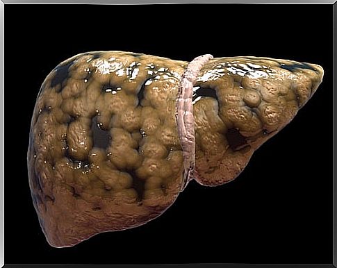 hepatic steatosis