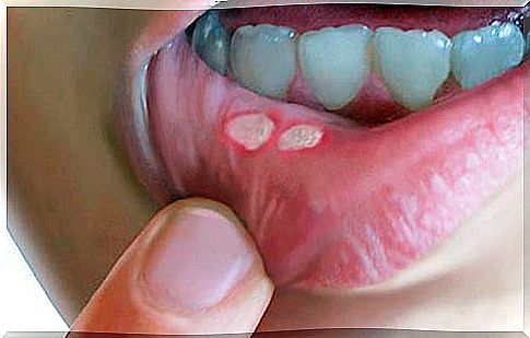 How to cure mouth sores with home remedies