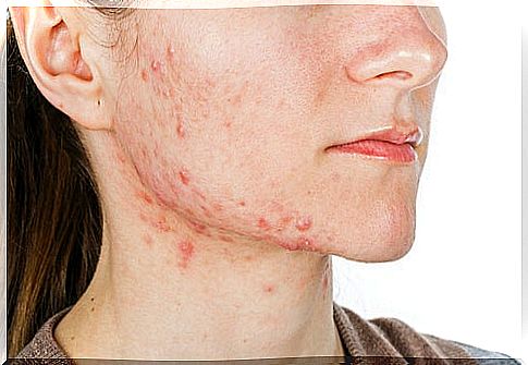 Woman with severe acne