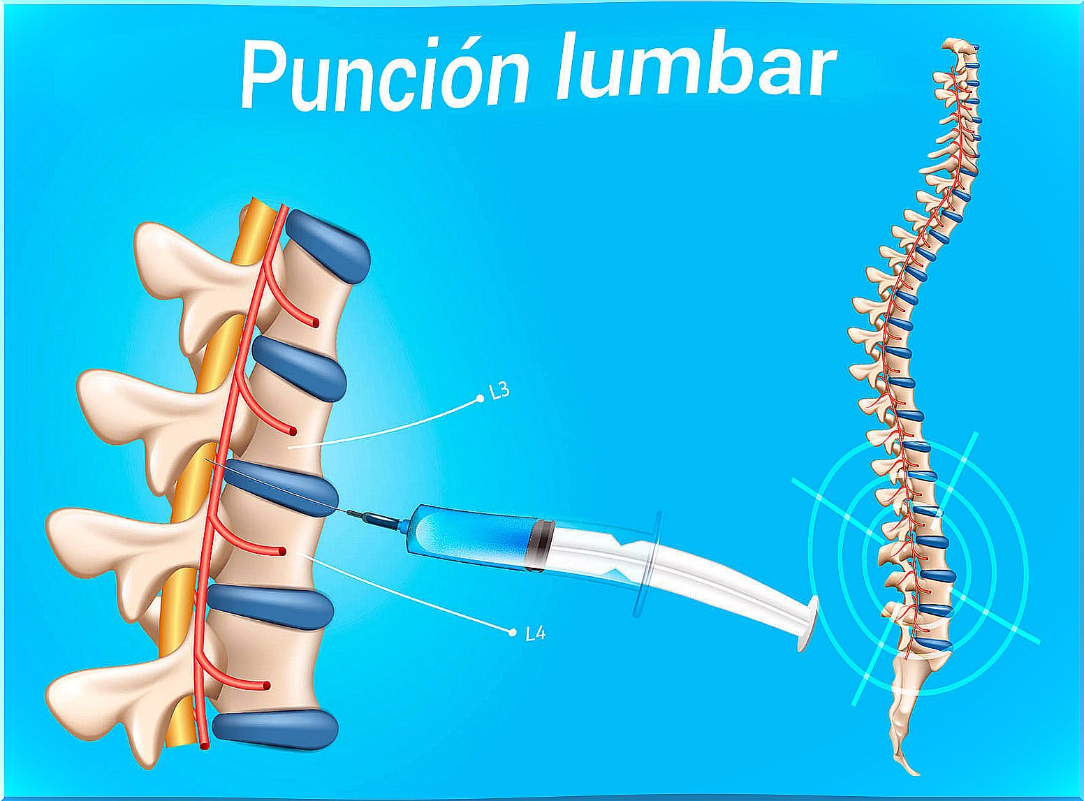 Lumbar puncture