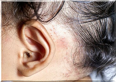 Girl with rash behind the ear