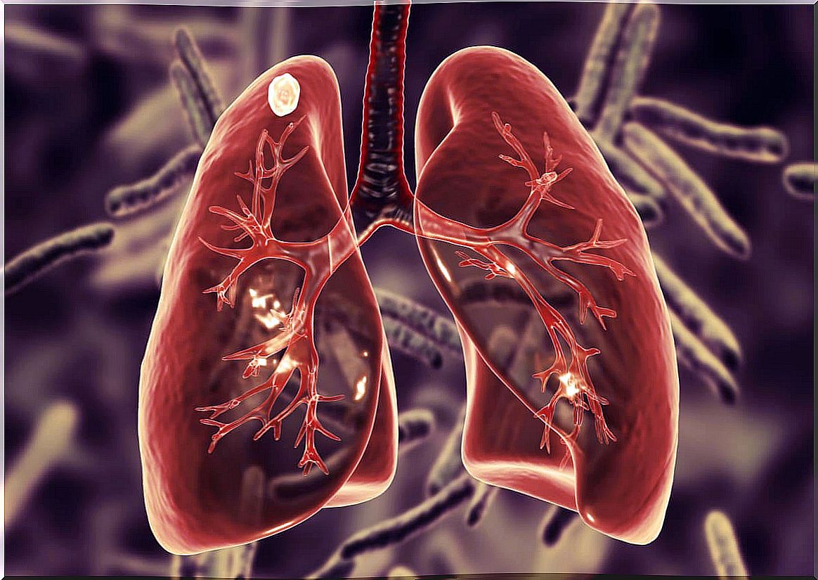 What is pulmonary tuberculosis and what are its symptoms?