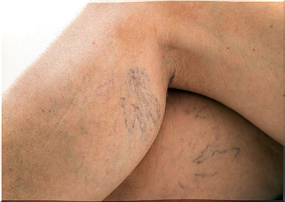 Varicose veins