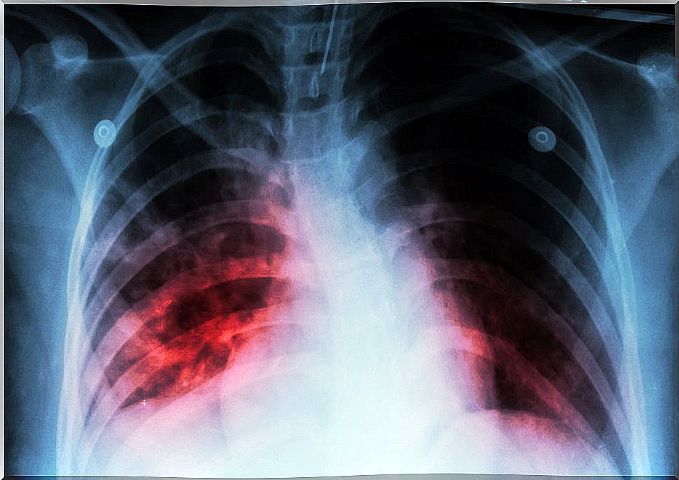 Example of X-rays to locate tuberculosis