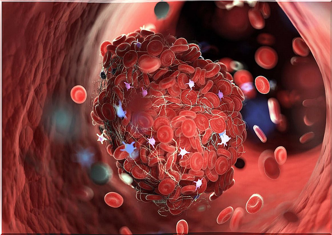 Blood clot from chronic inflammation.