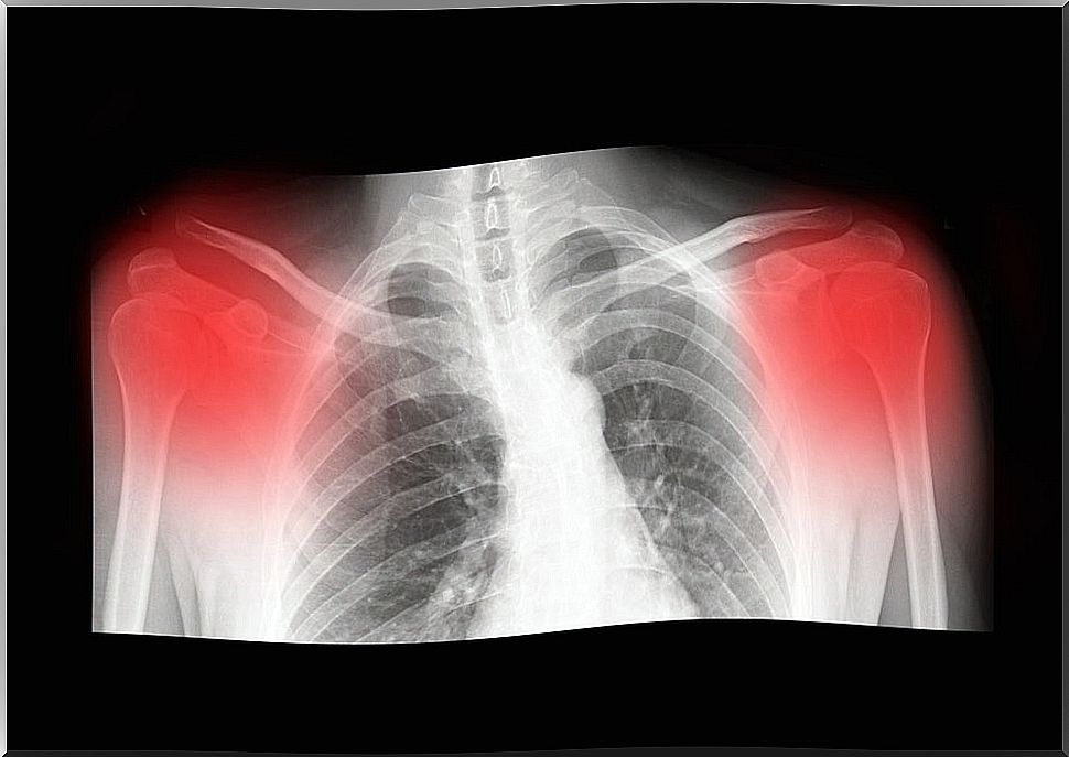 X-ray image showing inflammation in the clavicle joint