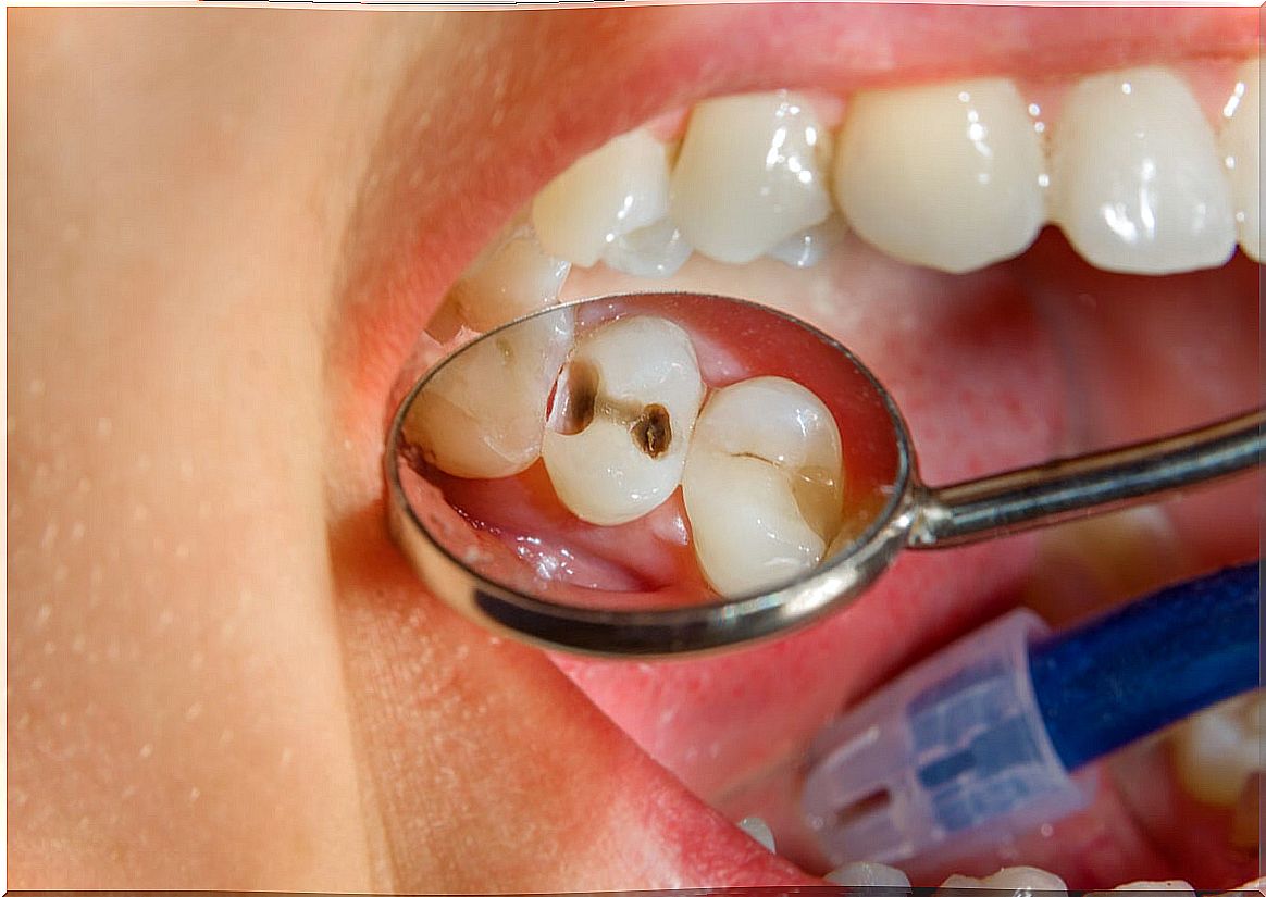 Tooth decay as a complication of a piercing.