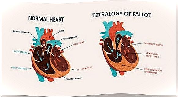 Tetralogy of Fallot